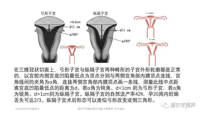 部分子宫畸形超声测量注意事项 - 7