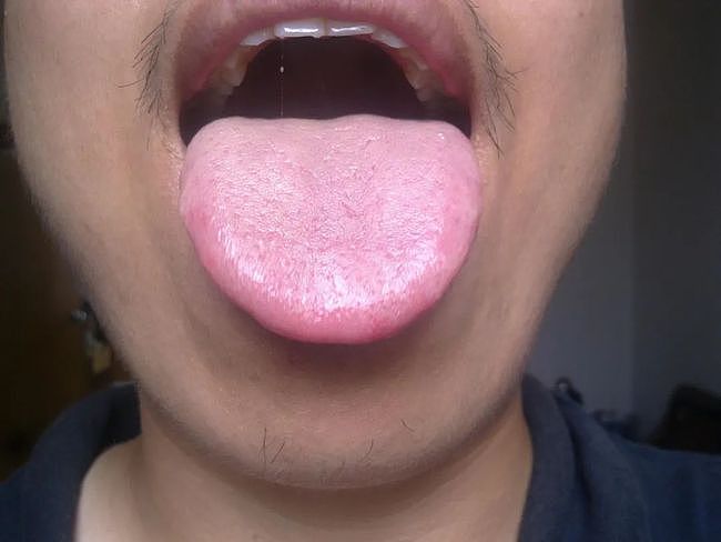 望舌探病，舌是脏腑的“本色反映”，这4种体质的人有不同的舌象 - 3