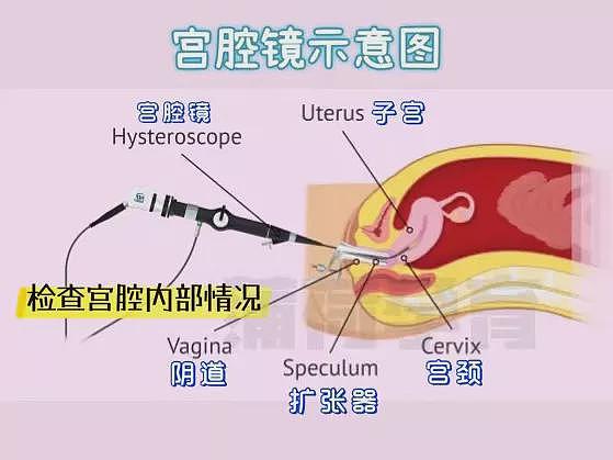 宫腔镜与腹腔镜究竟是怎么样的过程？ - 2