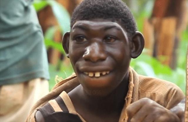 非洲男子得罕见怪病，长相似猴子，不吃饭只吃香蕉，被人当动物耍 - 6