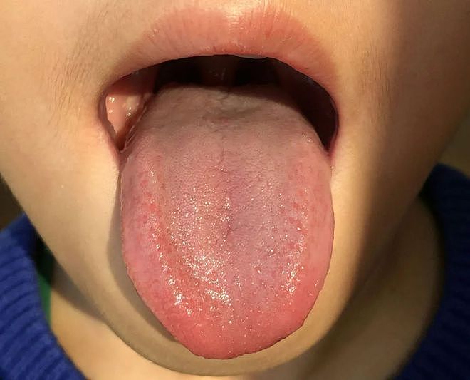 中医看病，为什么喜欢看舌头？其实这些舌象变化可以表达体内病变 - 2