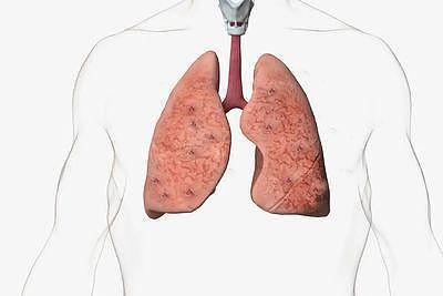 肺癌确诊后千万别走弯路！掌握3个关键很重要—抗癌管家 - 2