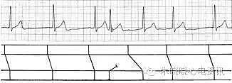 第六章 快速性心律失常的心电图诊断（浙江省心电图学专业岗位在职培训教材系列） - 5