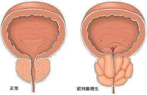 前列腺增生用经方五苓散合并桃核承气汤 - 1
