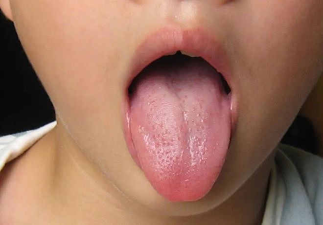 中医看病，为什么喜欢看舌头？其实这些舌象变化可以表达体内病变 - 3