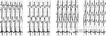 第六章 快速性心律失常的心电图诊断（浙江省心电图学专业岗位在职培训教材系列） - 13