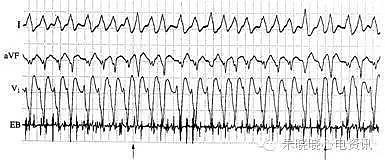 第六章 快速性心律失常的心电图诊断（浙江省心电图学专业岗位在职培训教材系列） - 14