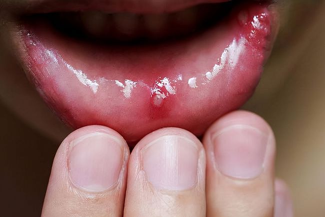 口腔溃疡反反复复？提醒：溃疡有这些特点，小心跟舌癌有关系！ - 1