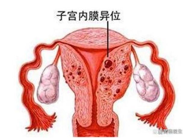关爱子宫内膜健康，警惕子宫内膜增生 - 1