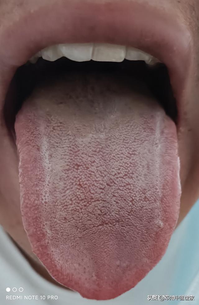 焦虑症治疗前后的舌象对比 - 2