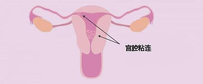 这影响月经、怀孕，让胚胎难以着床的宫腔粘连！ - 2