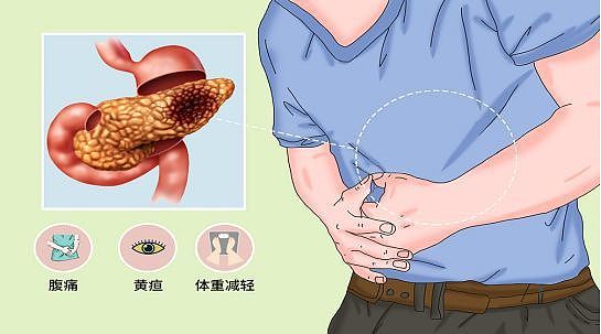 “癌王”胰腺癌，很多人误以为是胃病！出现几个症状，及时就医 - 1