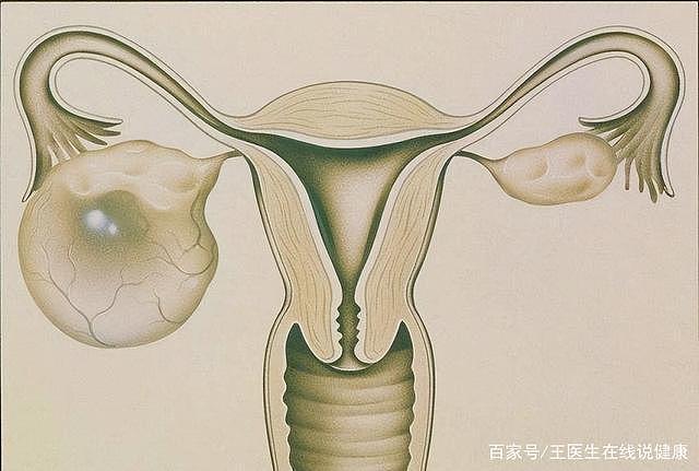 什么是卵巢囊肿？小小年纪怎么也会得？ - 4
