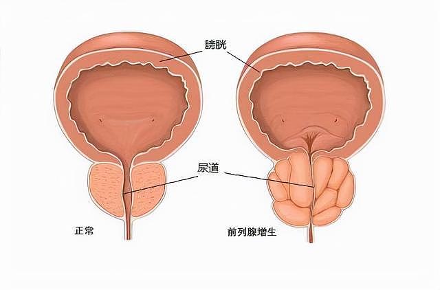 前列腺被称生命腺，医生提醒：男人50岁后，要警惕3类前列腺疾病 - 2