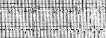 第六章 快速性心律失常的心电图诊断（浙江省心电图学专业岗位在职培训教材系列） - 3