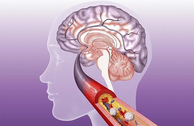 脑小血管病起病隐匿，是血管性认知功能障碍的主要原因，危害较大 - 2