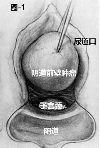 病例分享 | 少见的尿道旁肿瘤——阴道尿道旁平滑肌瘤一例 - 2