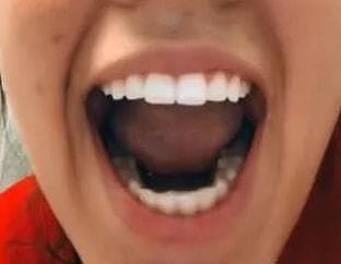 牙不齐就学网红用指甲锉磨牙？！牙医看了想打人…… - 3