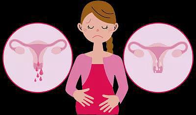 这影响月经、怀孕，让胚胎难以着床的宫腔粘连！ - 4