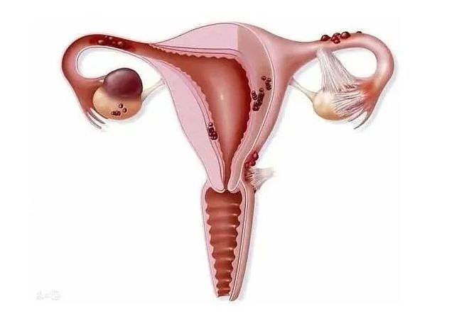 卵巢囊肿多大就需要做手术 - 2