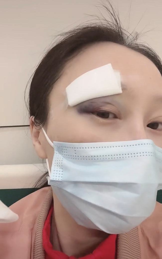 35岁女星意外毁容要退圈！眼角淤青缝九针，曾自曝产后患病想跳楼 - 3