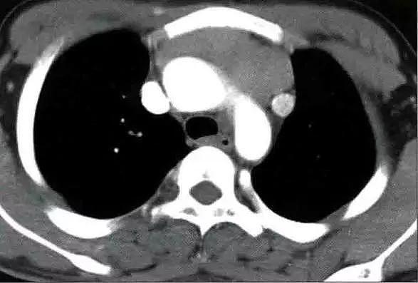 胸腺增生的影像表现及诊断 - 1