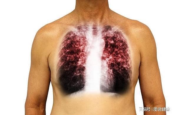 肺癌来临，别只想到烟草，还可能是这3类因素导致，别忽视！ - 1
