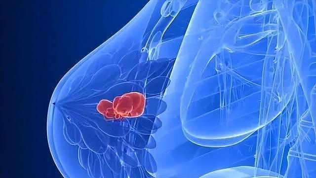 「病例实录」45岁单亲妈妈罹患乳腺癌，注意这个是患癌的元凶 - 1
