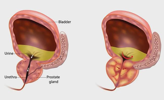 面对前列腺增生年轻化：中青年男性发现前列腺增生怎么办？ - 1