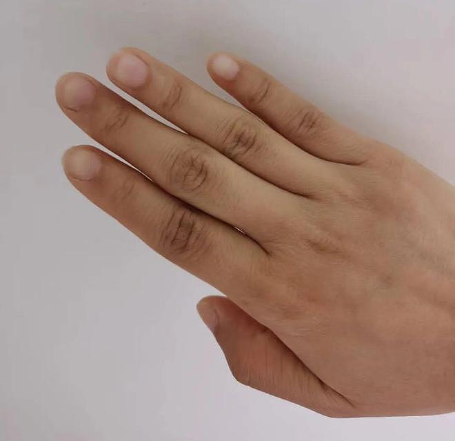 指甲上的竖纹是肝病引起的？其实也可能是这3个原因，不必担心 - 2