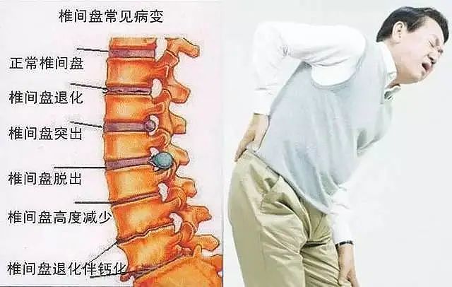 男子腰椎间盘突出3年不重视，导致双下肢瘫痪 - 1