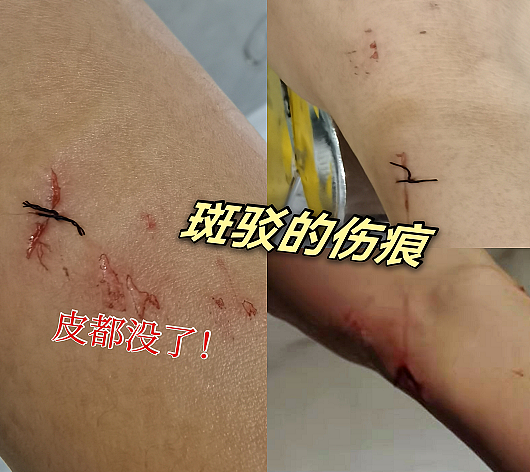 女星王钰雯在酒店遇意外，洗澡时玻璃门突然炸裂，手腕胳膊都受伤 - 6
