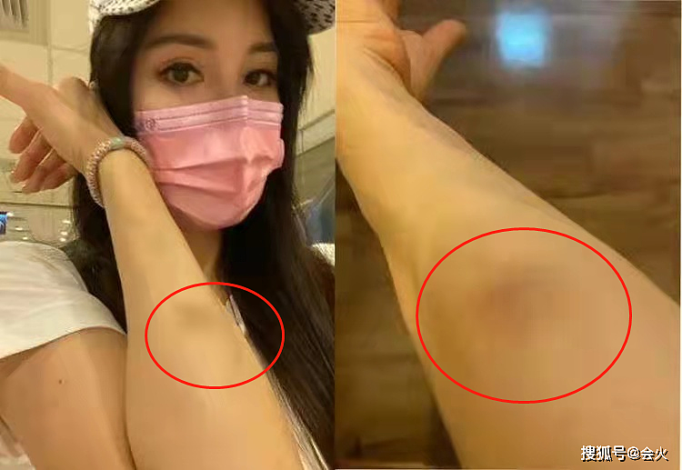 52岁杨丽菁在医院被人殴打！手臂大块淤青凄凉，场面混乱无人劝阻 - 2
