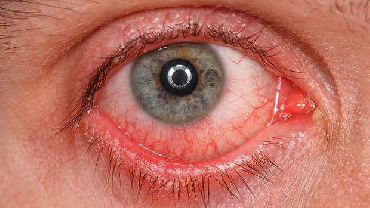青光眼是什么原因造成的？导致青光眼的原因分析