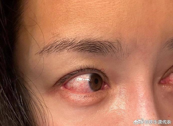 演员@李依晓 在社交平台晒出一些伤痕照，她透露连续拍了几天的情绪戏… - 2