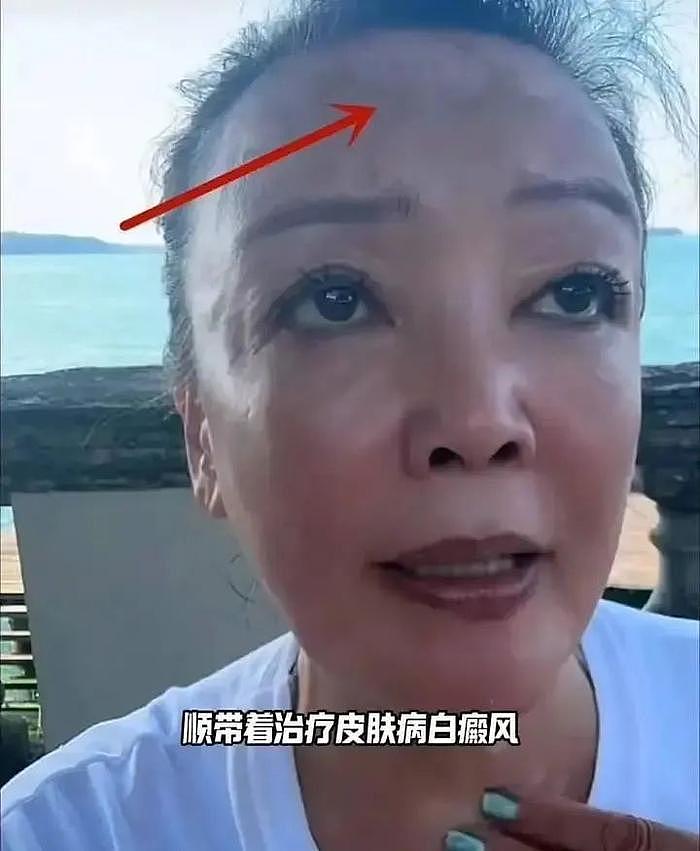 张兰前往意大利求医！不是她不信国内医疗水平，背后原因无需细说 - 3