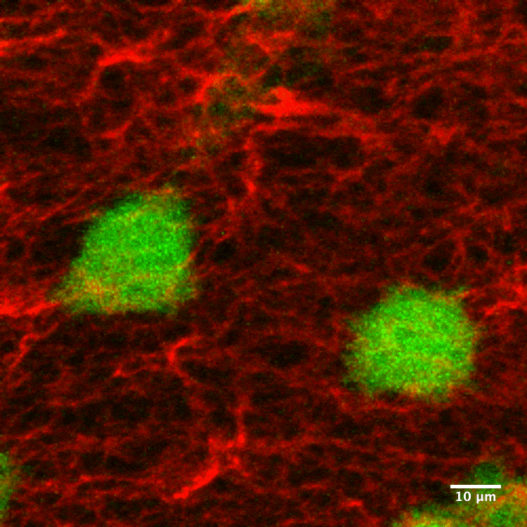 图中是肿瘤细胞在I型胶原蛋白基质，它们处于活跃增殖状态。我们看到的肿瘤细胞绿色部分是显微镜下监测到的癌细胞活动周期