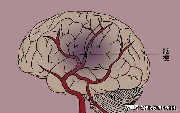 为何脑梗逐年增多？医生：和肥肉无关，推手或是这1调味品 - 1