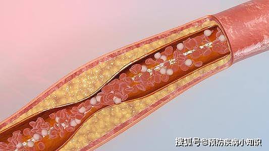 为何“脑梗”患者越来越多？医生：坚持做好5件事，或助预防脑梗 - 2