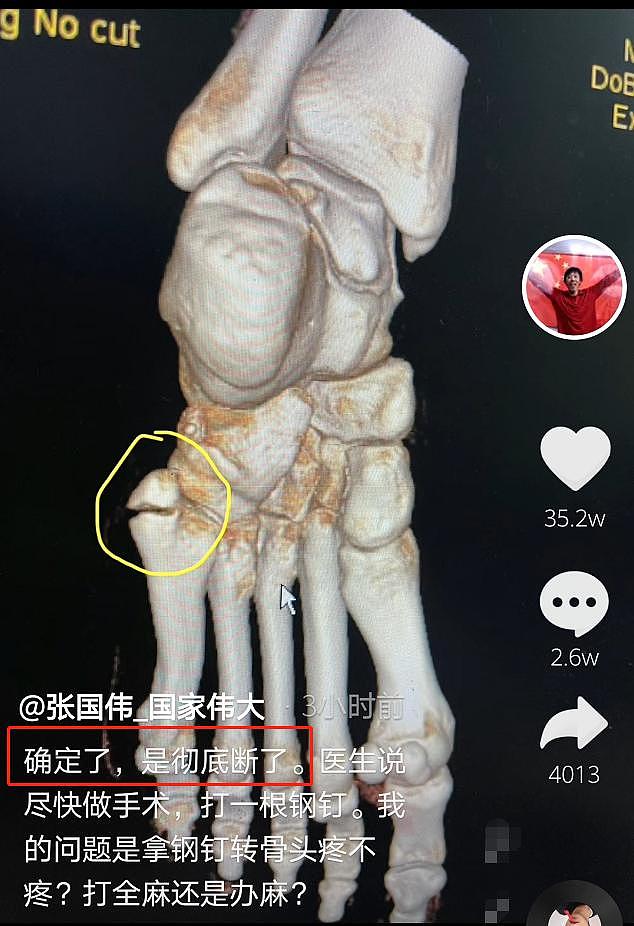 30岁跳高名将张国伟骨折，CT照曝光裂痕明显，刚官宣复出1个月 - 3