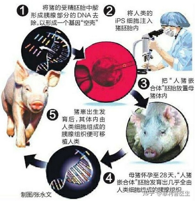 世界首例猪肾移植人体手术测试初步成功，这项技术有什么价值？ - 5