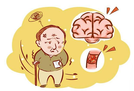 预防脑梗和血管堵塞吃什么药  脑梗前有8个征兆 - 1