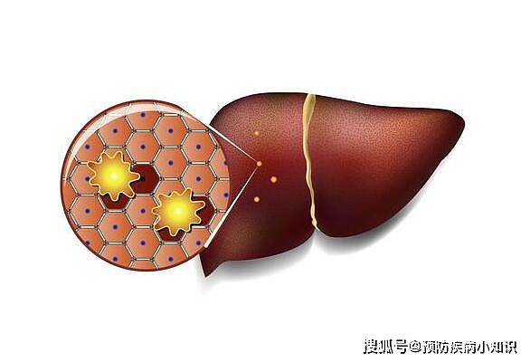 身体无故出现4种状况，或是脂肪肝的“脚步声”，趁早检查肝功能 - 1