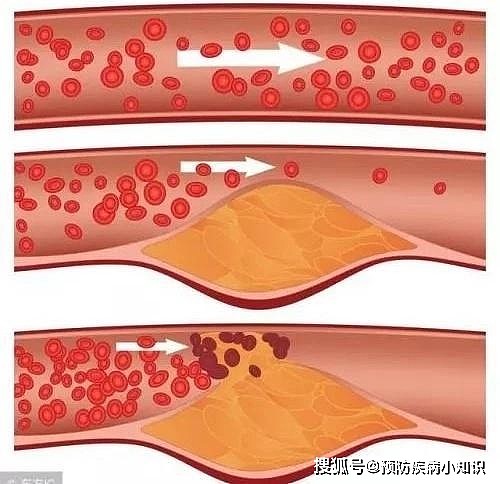 32岁教师脑梗离世，医生提醒：这3种素菜天天吃，脑梗找上门 - 2