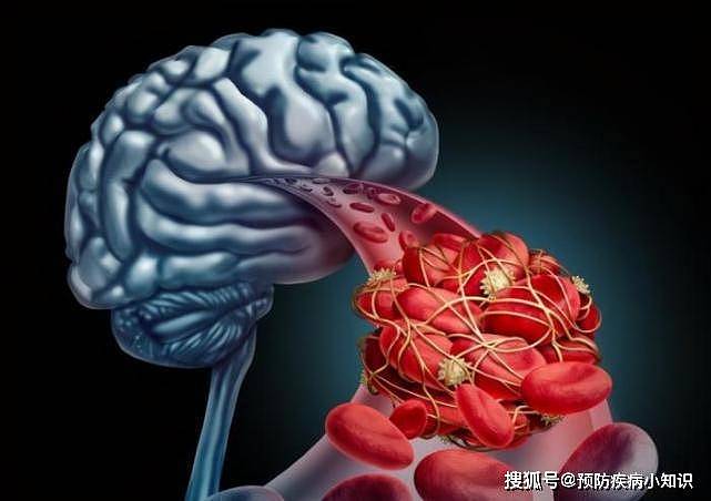 为何越来越多年轻人发生脑梗死?医生：4个因素要考虑 - 2