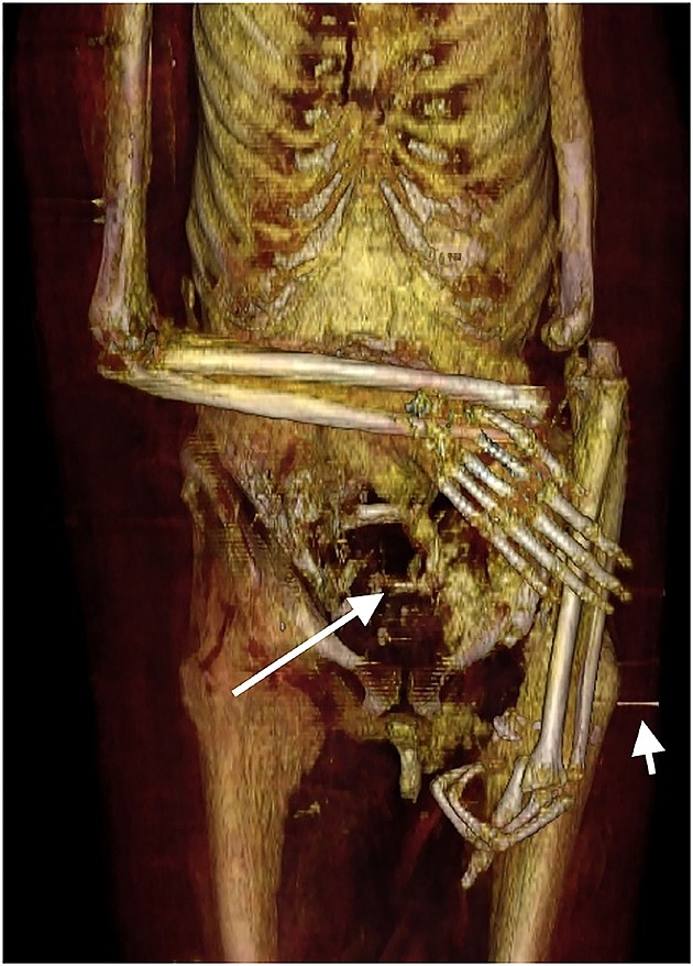 扫描显示阿蒙霍特普一世的木乃伊曾遭盗墓者的破坏。