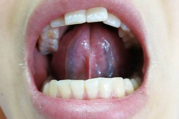 舌下有青筋，是怎么回事？青筋出现2种异常时，要注意 - 1