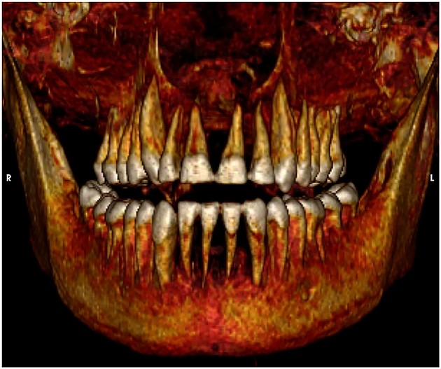 阿蒙霍特普一世牙齿状况良好。