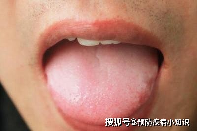 舌头是胃的“晴雨表”，胃部有疾病，舌头先知道 - 5