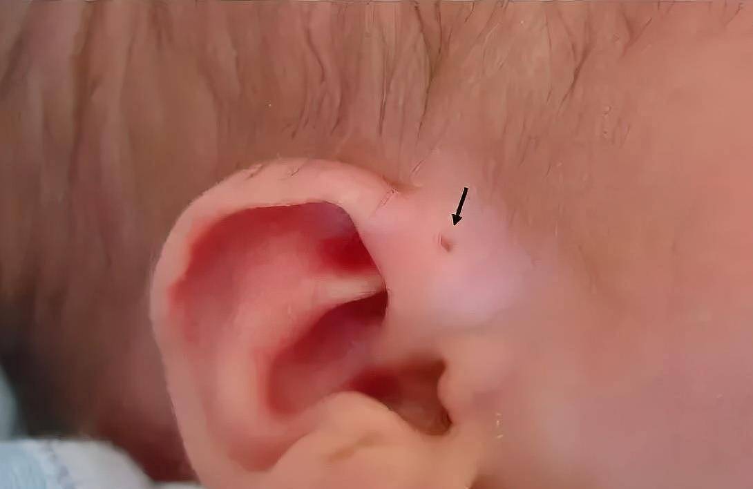 狐大医 | 警惕！宝宝耳朵前有“小洞”可能让他永久失聪 - 1